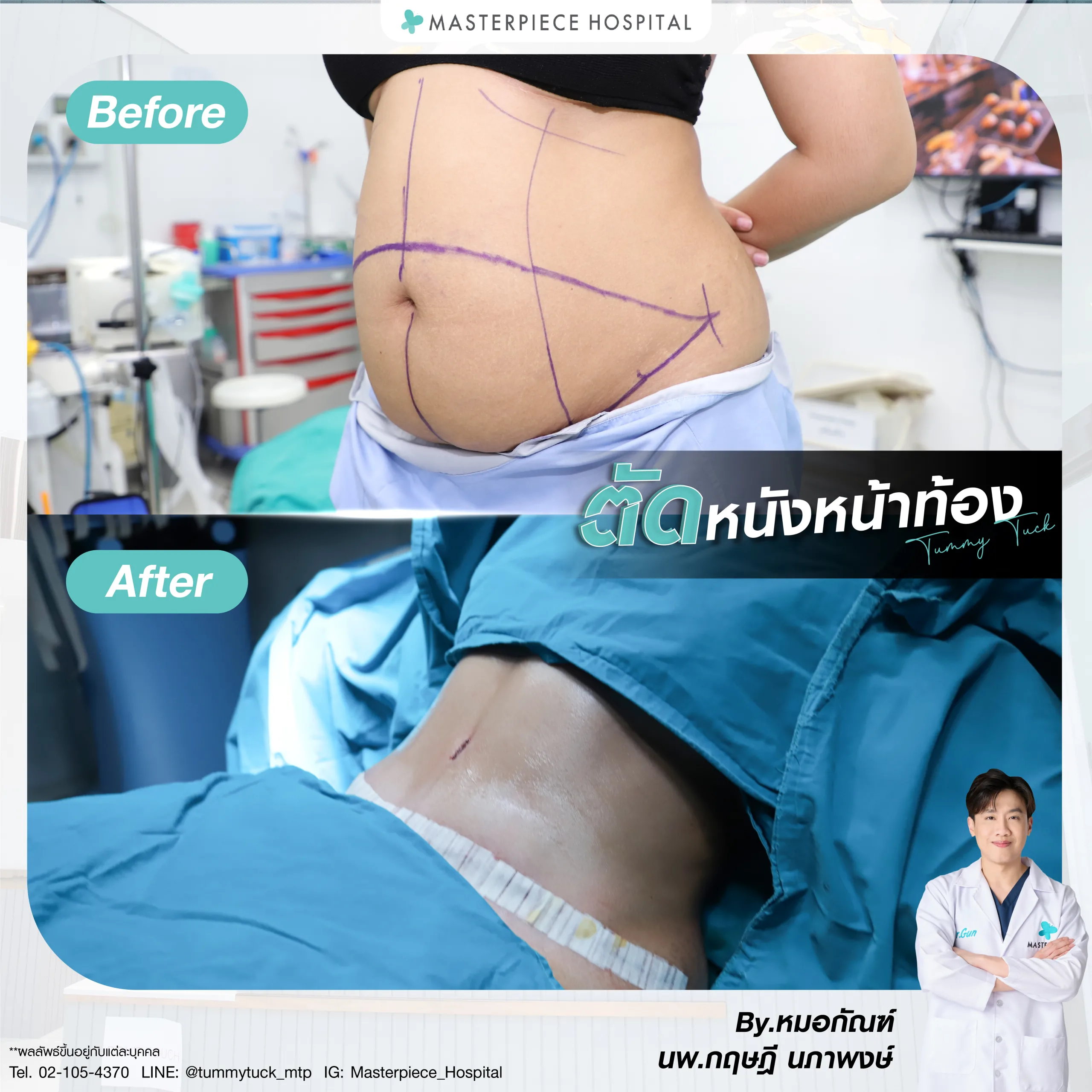 รีวิวการตัดหนังหน้าท้อง