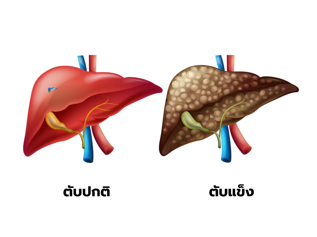 ภาวะแทรกซ้อนของโรคตับแข็ง