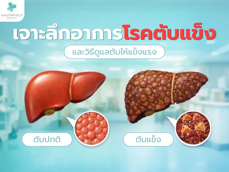 เจาะลึกอาการโรคตับแข็ง และวิธีดูแลตับให้แข็งแรง