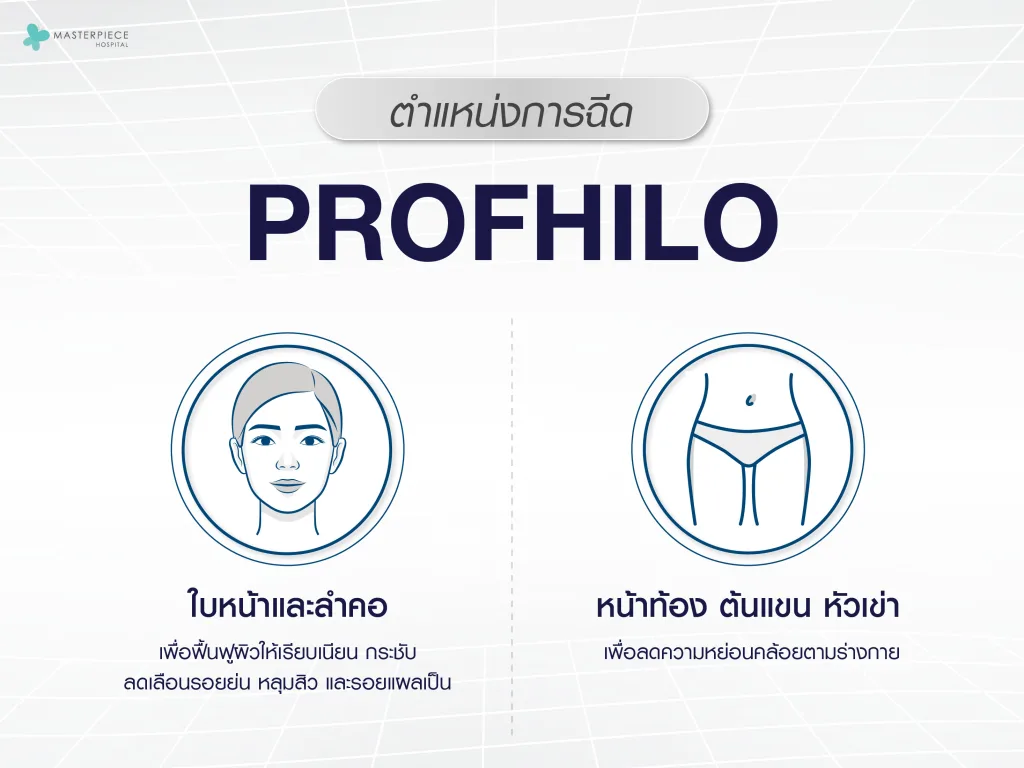 ตำแหน่งการฉีด Profhilo