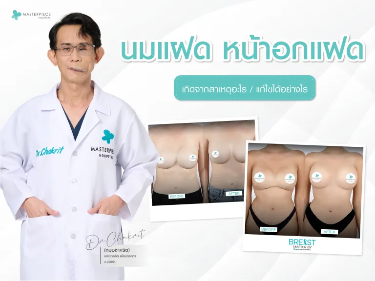 นมแฝด อกแฝด เกิดจากสาเหตุอะไร แก้ไขได้อย่างไร ?