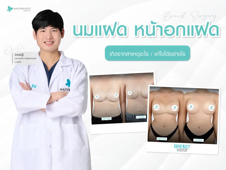 นมแฝด อกแฝด เกิดจากสาเหตุอะไร แก้ไขได้อย่างไร ?