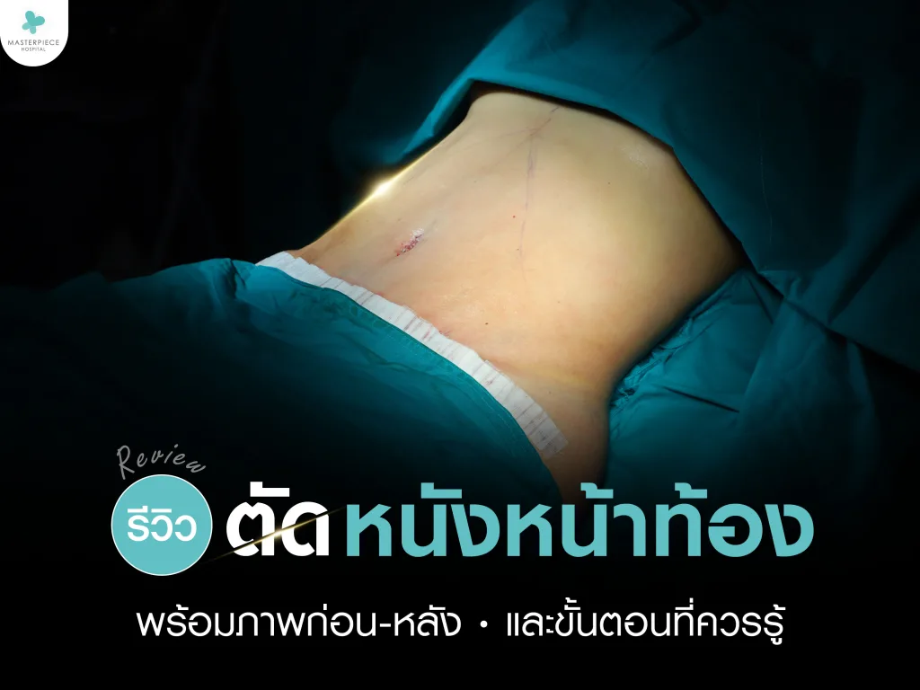 รีวิวตัดหนังหน้าท้อง พร้อมภาพก่อน–หลัง และขั้นตอนที่ควรรู้