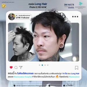 รีวิวปลูกผมคุณจเด็จ