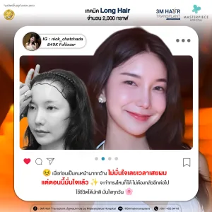 รีวิวปลูกผมคุณนิก