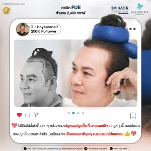 รีวิวปลูกผมคุณเสนาหอย