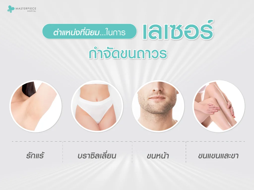 ตำแหน่งที่นิยมในการทำเลเซอร์กำจัดขน