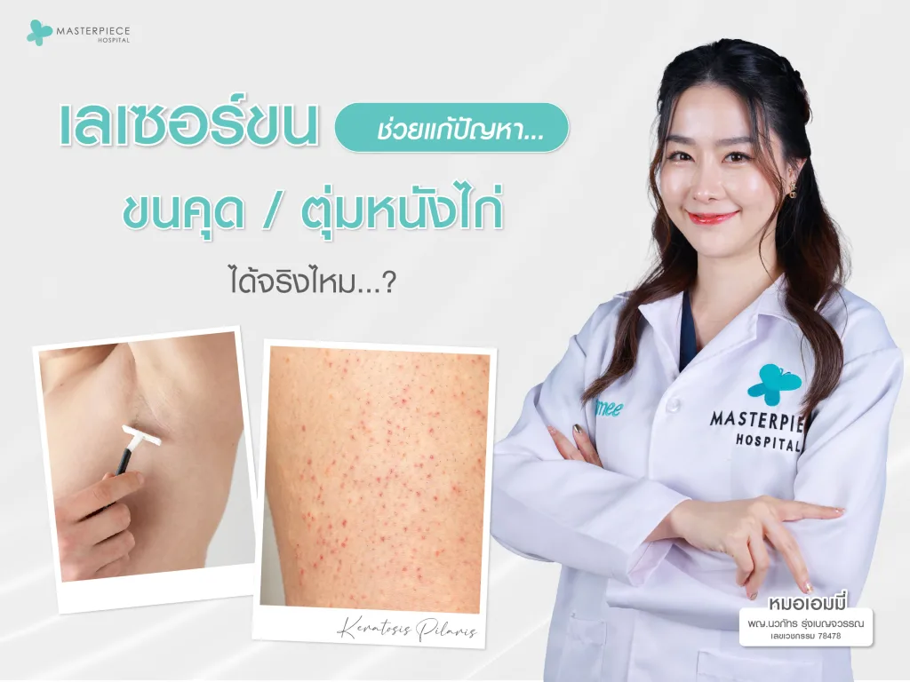 เลเซอร์ขนช่วยแก้ปัญหา "ขนคุด" และ "ตุ่มหนังไก่" ได้จริงไหม