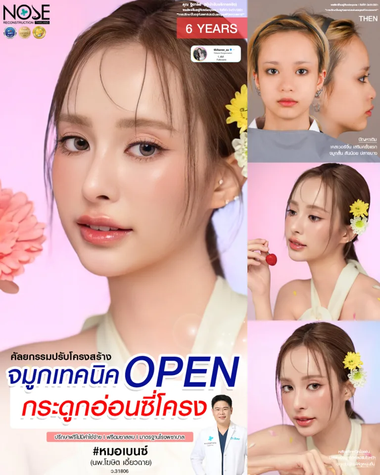 รีวิวจมูกเทคนิค open กระดูกอ่อนซี่โครง หมอเบ็นซ์