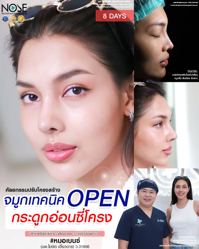 รีวิวจมูกเทคนิค open กระดูกอ่อนซี่โครง หมอเบ็นซ์