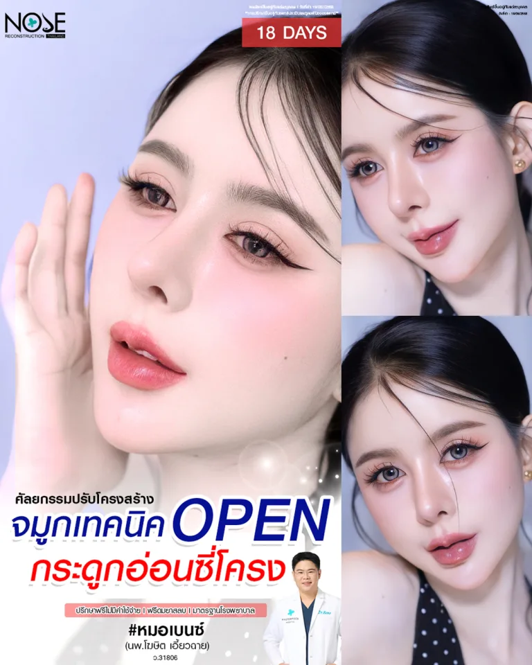 รีวิวจมูกเทคนิค open กระดูกอ่อนซี่โครง หมอเบ็นซ์
