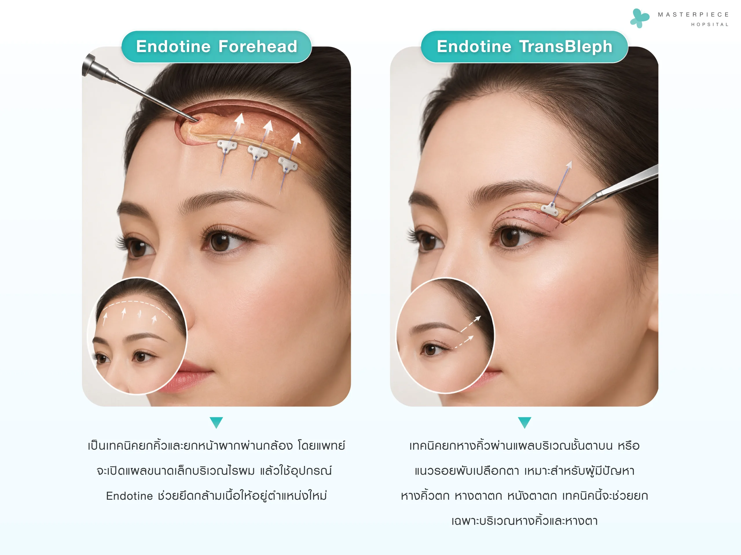 การยกคิ้วด้วย Endotine มีกี่เทคนิค?