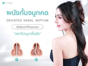 ผนังกั้นจมูกคด (Deviated Nasal Septum) ภัยเงียบทำให้นอนกรนและคัดจมูกเรื้อรัง