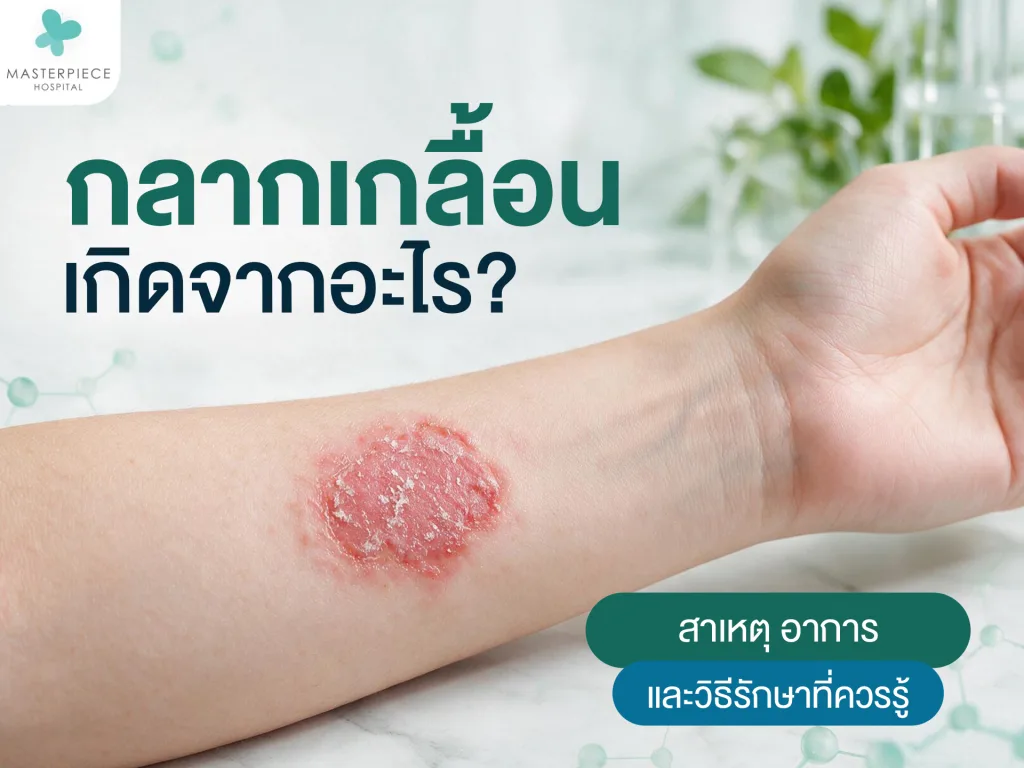 กลากเกลื้อนเกิดจากอะไร? สาเหตุ อาการ และวิธีรักษาที่ควรรู้