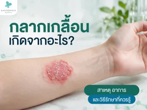 กลากเกลื้อนเกิดจากอะไร? สาเหตุ อาการ และวิธีรักษาที่ควรรู้