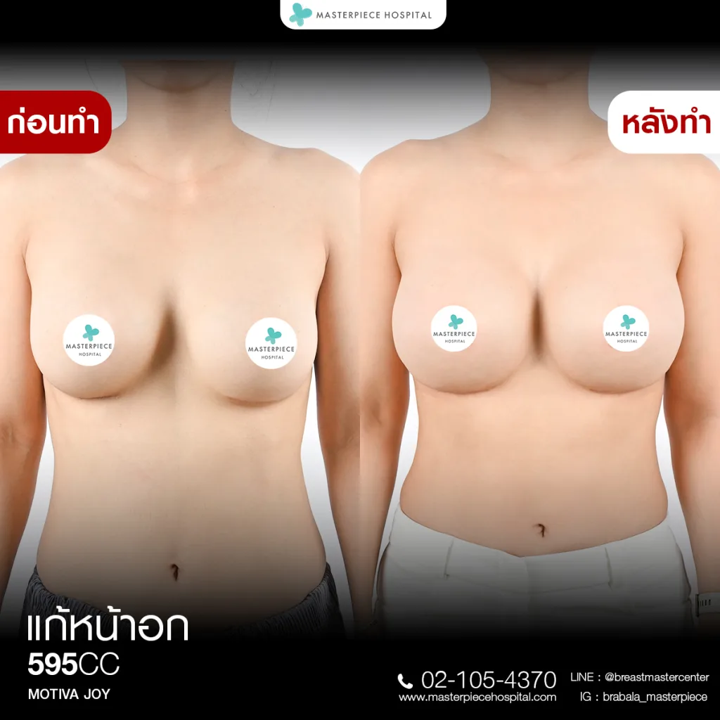 Before & After แก้หน้าอก 1