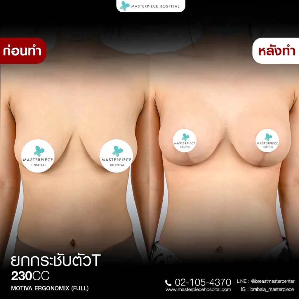 Before & After ยกกระชับหน้าอก 1