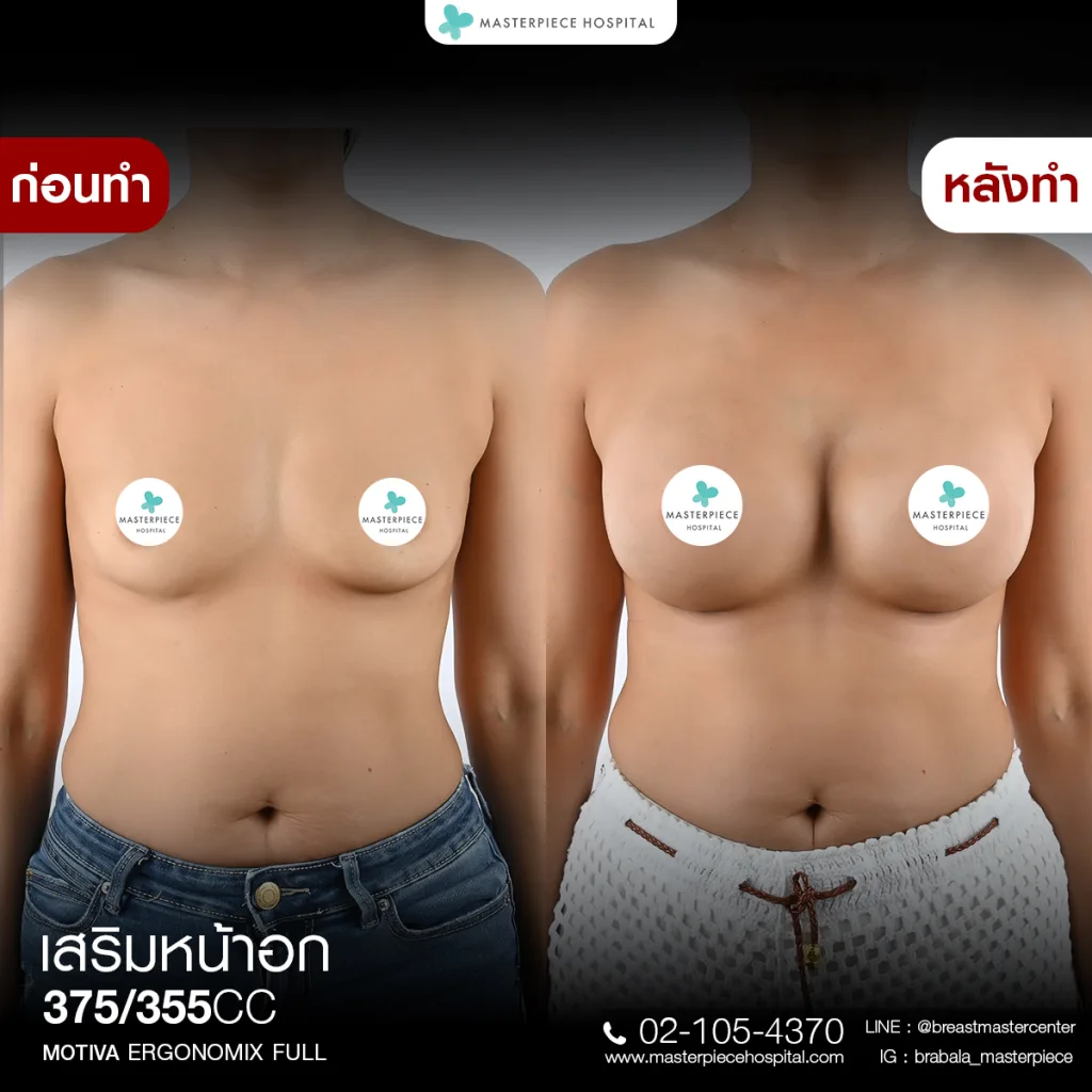 Before & After เสริมหน้าอก 1