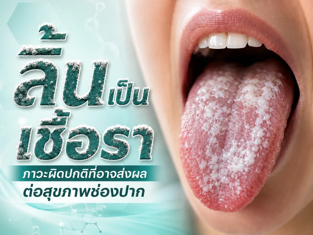 ลิ้นเป็นเชื้อรา ภาวะผิดปกติที่อาจส่งผลต่อสุขภาพช่องปาก