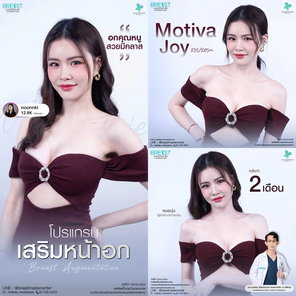 รีวิว เสริมหน้าอก 10
