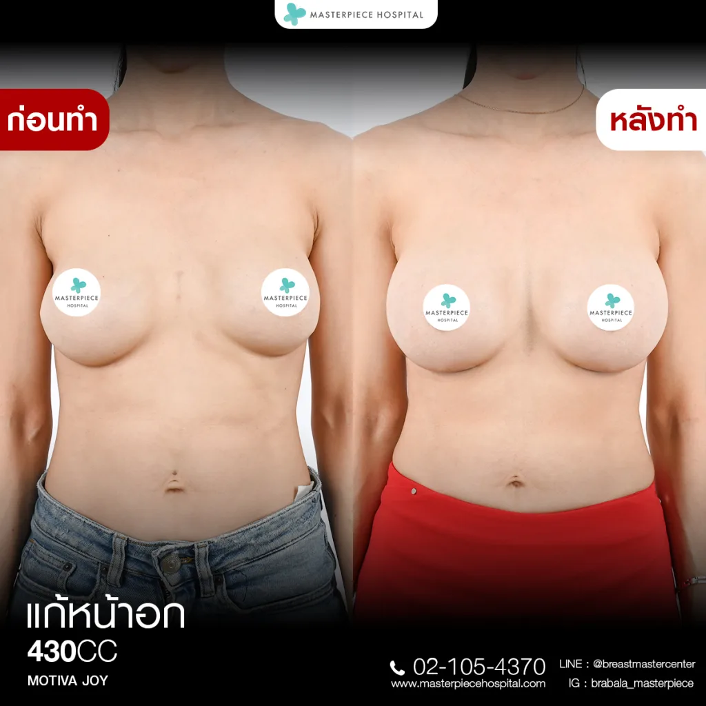 Before & After แก้หน้าอก 2