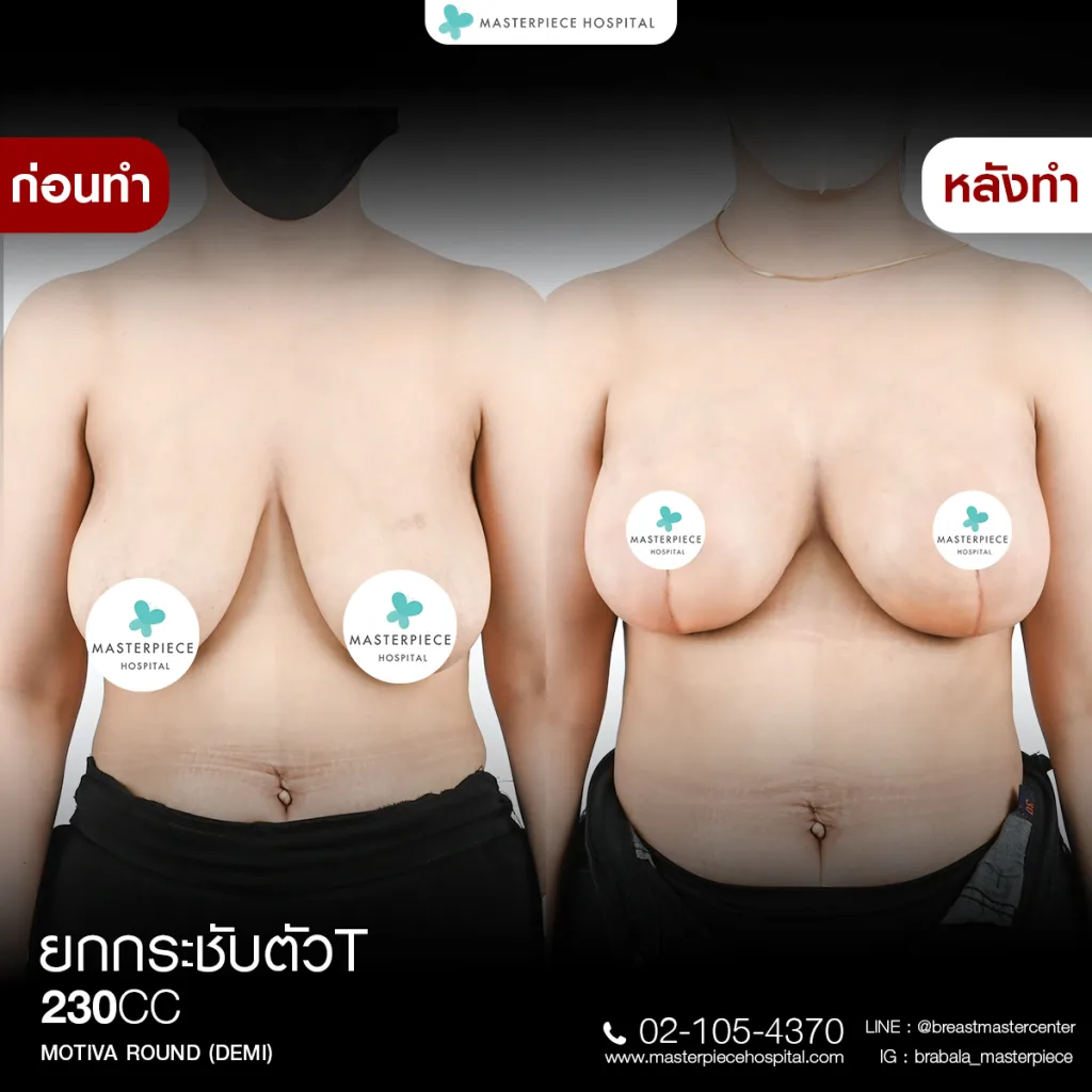 Before & After ยกกระชับหน้าอก 2