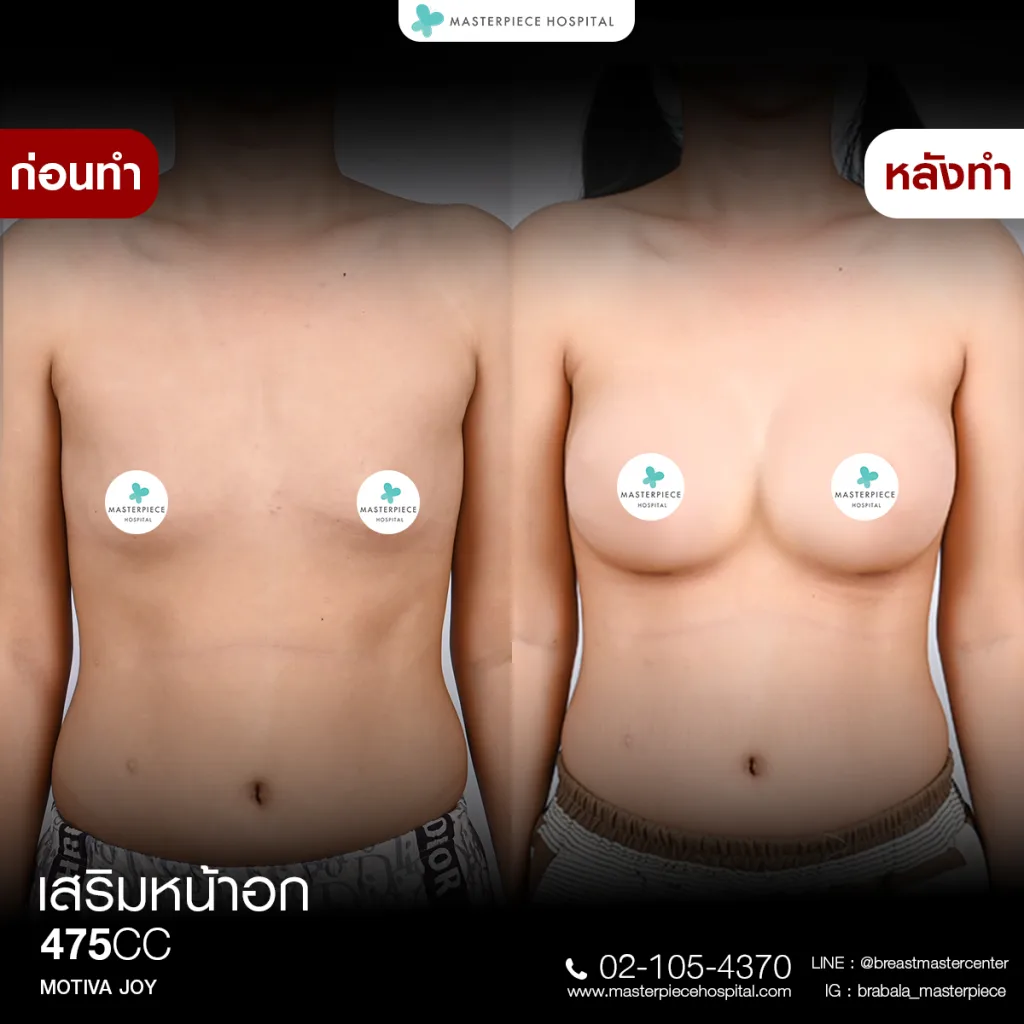 Before & After เสริมหน้าอก 2