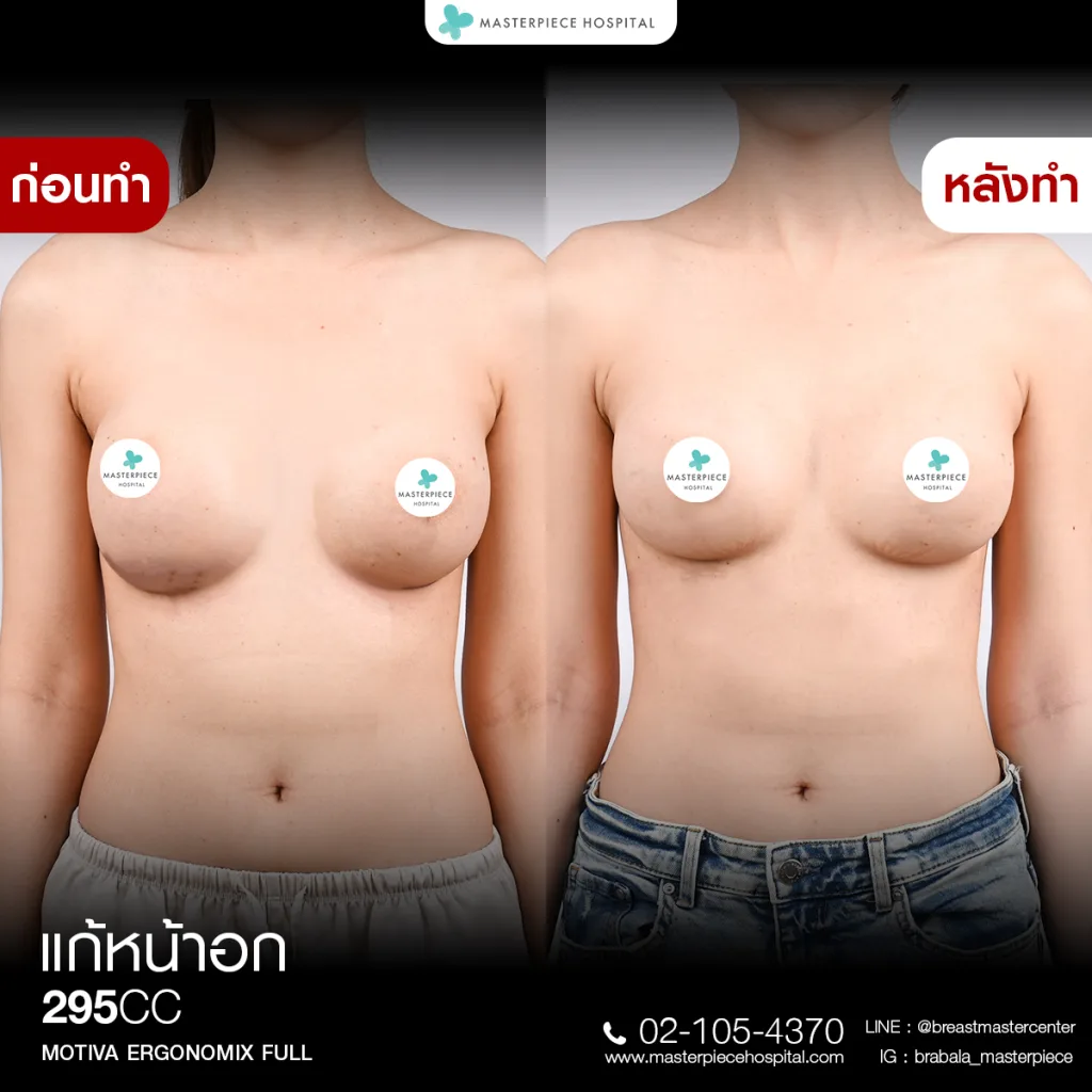 Before & After แก้หน้าอก 3
