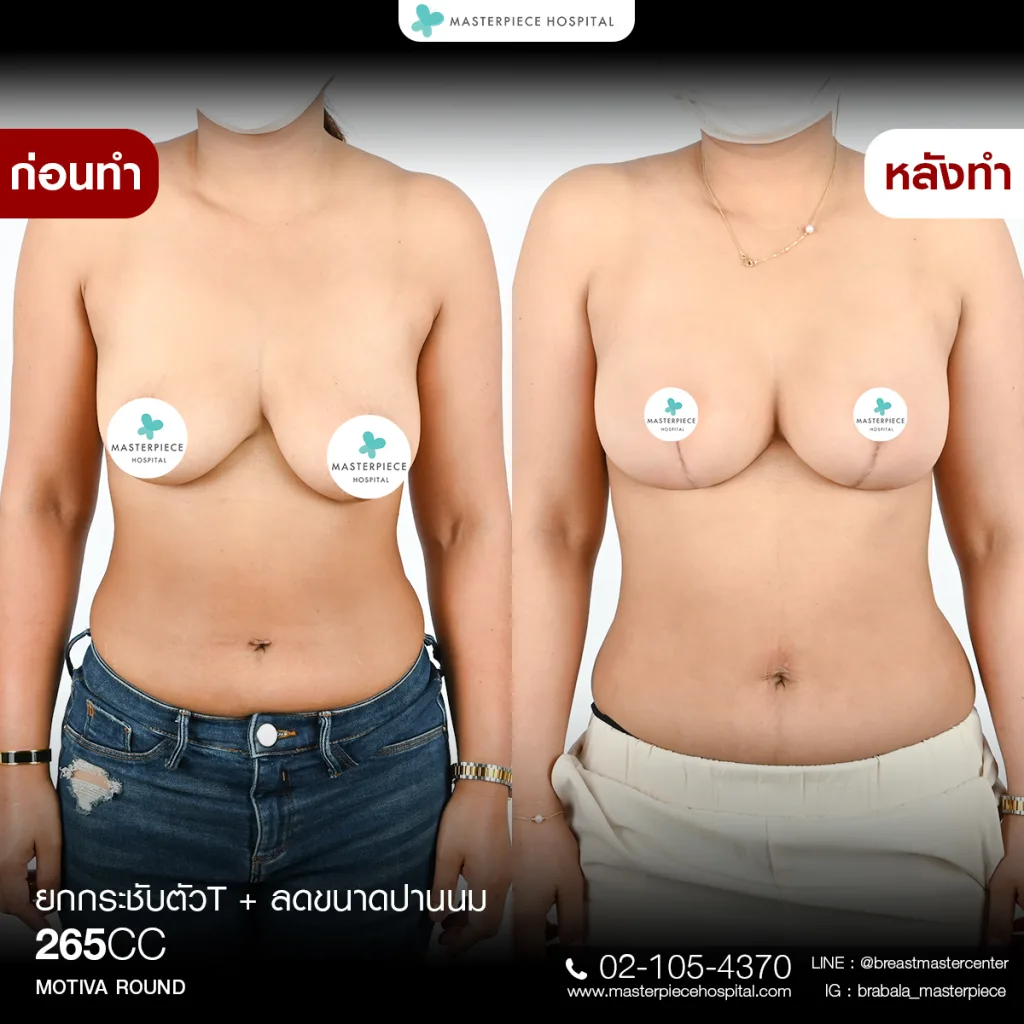 Before & After ยกกระชับหน้าอก 3