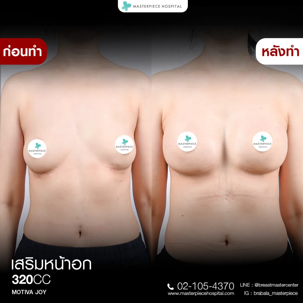Before & After เสริมหน้าอก 3