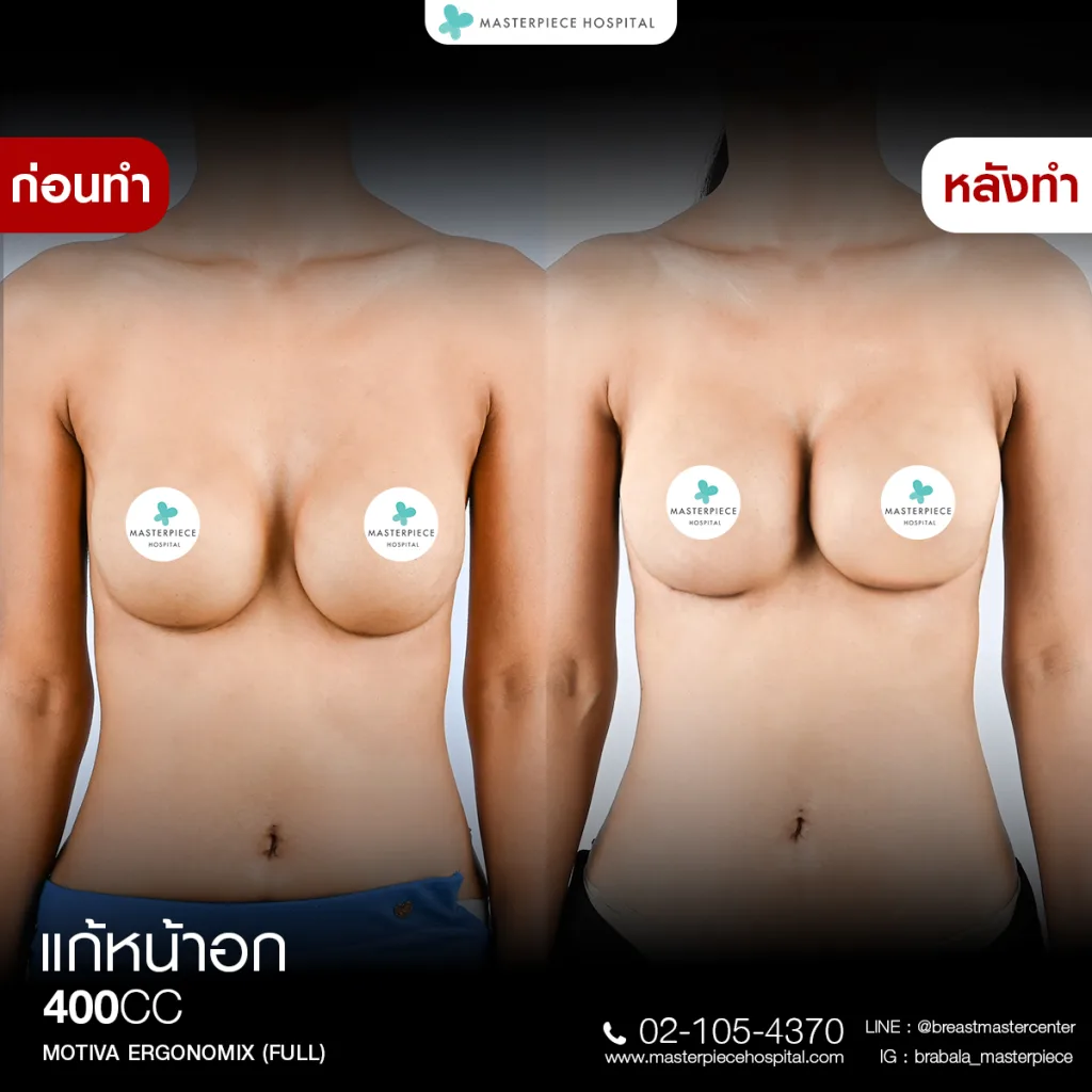 Before & After แก้หน้าอก 4