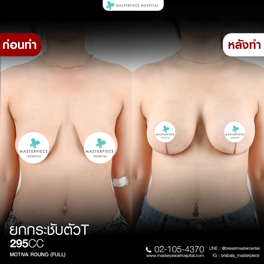Before & After ยกกระชับหน้าอก 4