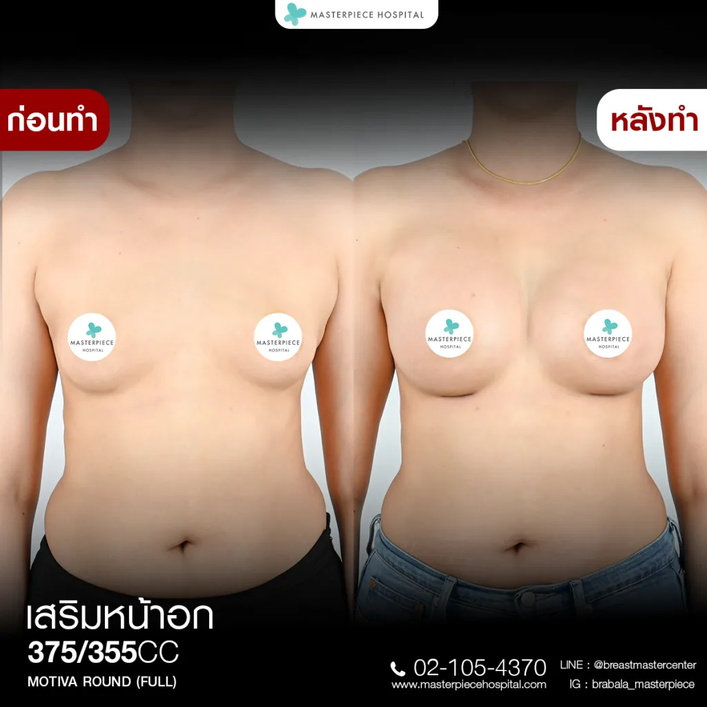 Before & After เสริมหน้าอก 4