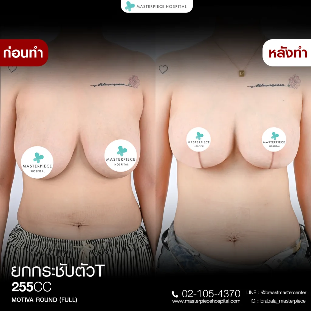 Before & After ยกกระชับหน้าอก 5