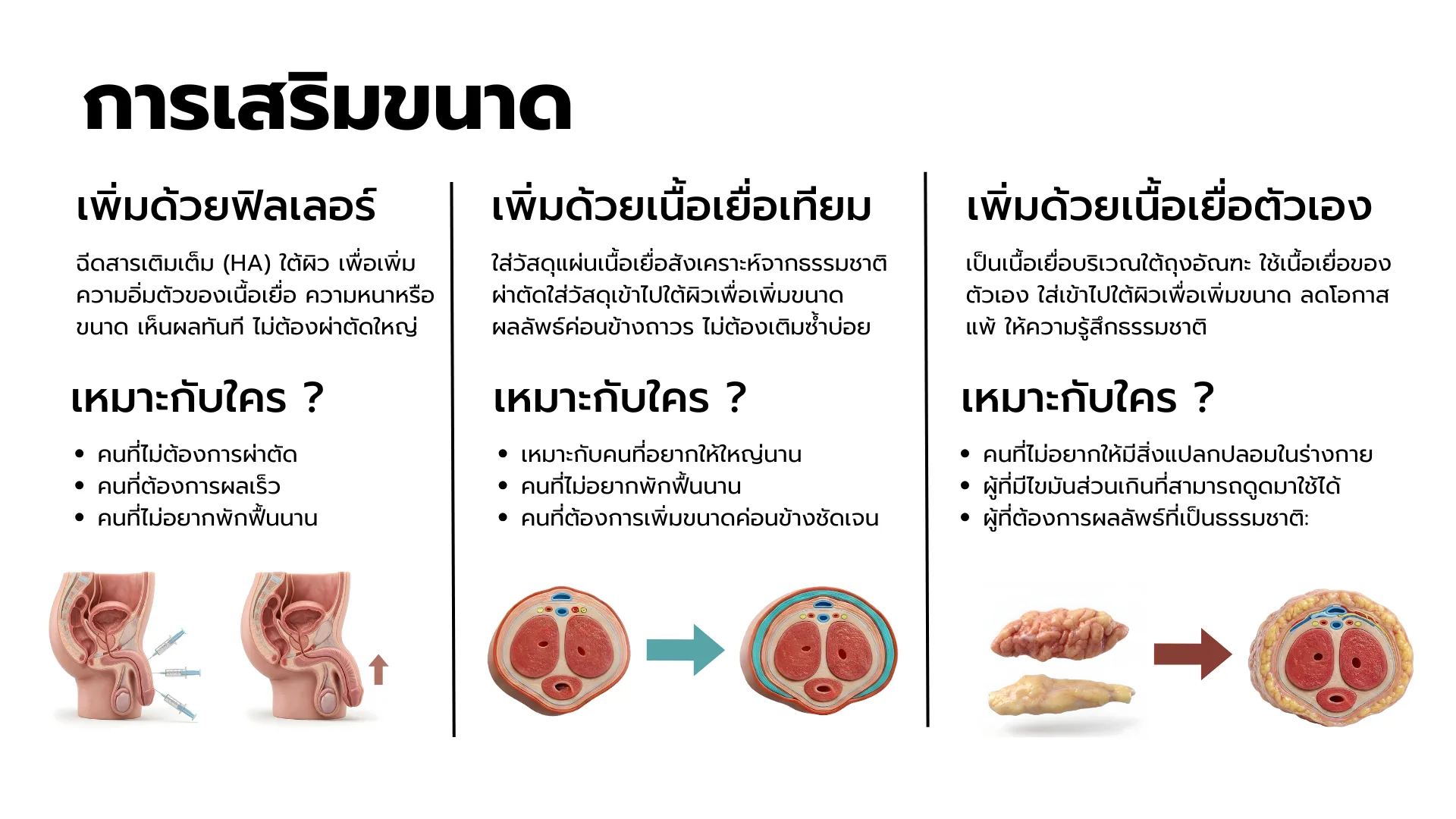 เสริมขนาดด้วย Filler