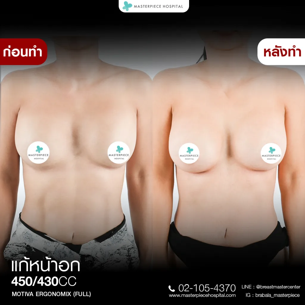 Before & After แก้หน้าอก 6