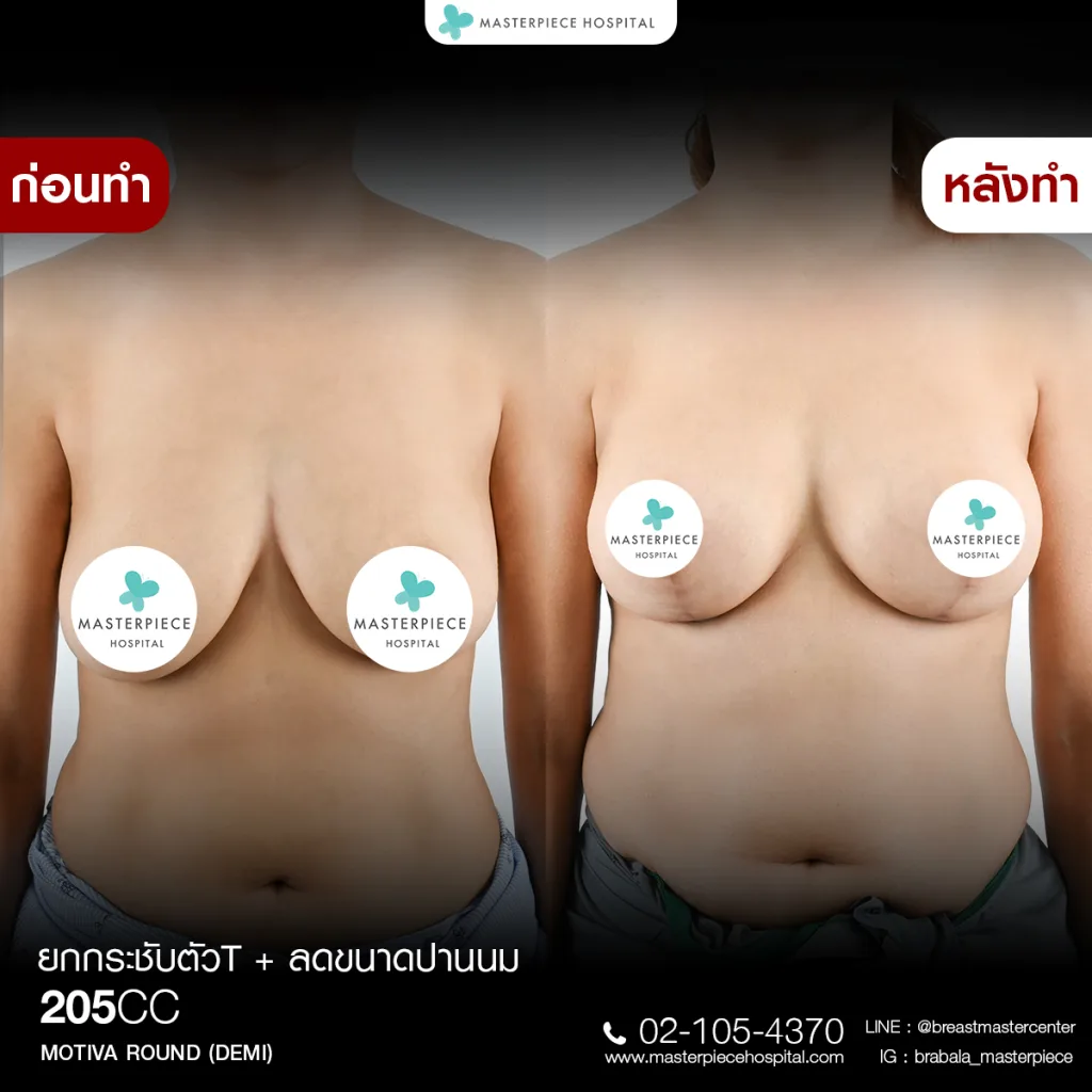 Before & After ยกกระชับหน้าอก 6