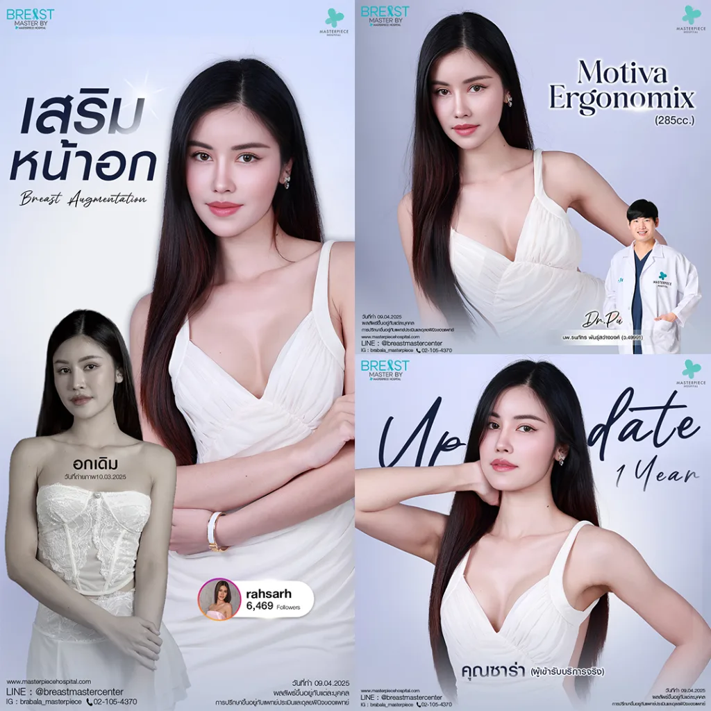 รีวิว เสริมหน้าอก 7