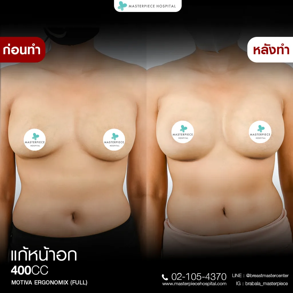 Before & After แก้หน้าอก 7