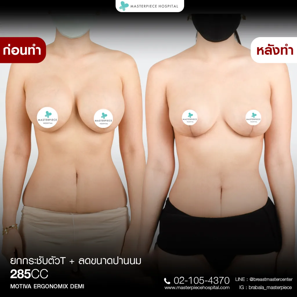 Before & After ยกกระชับหน้าอก 7