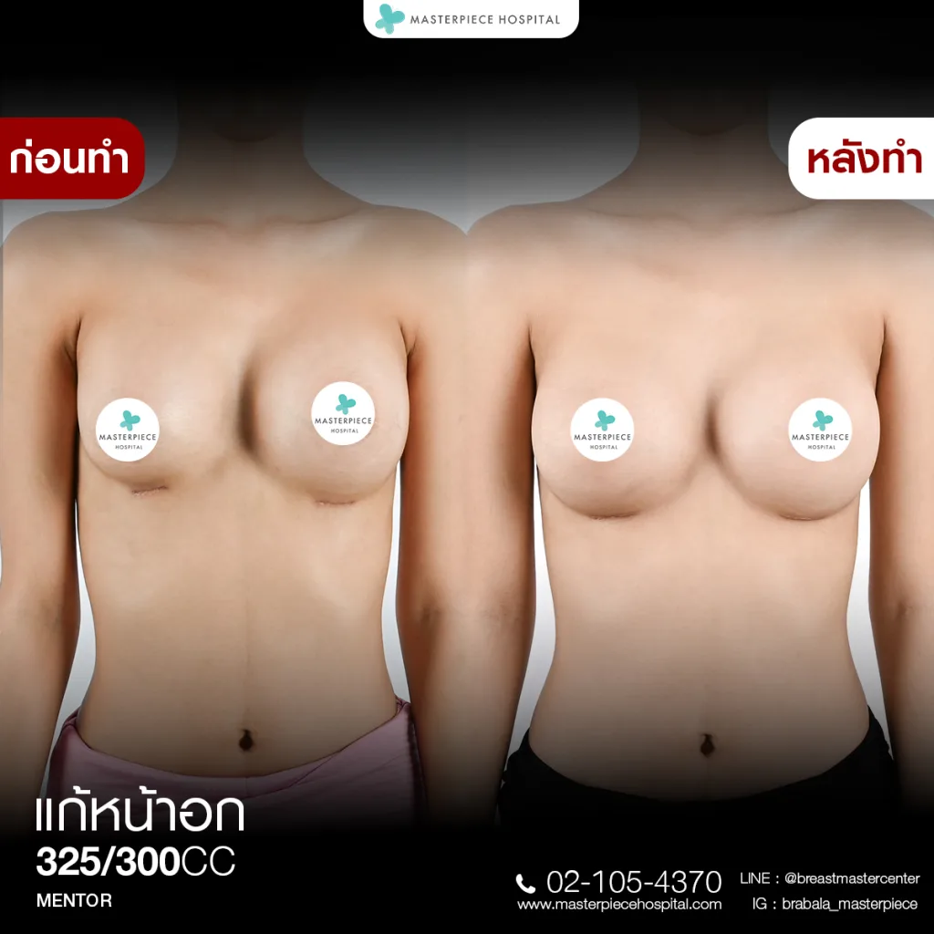 Before & After แก้หน้าอก 8