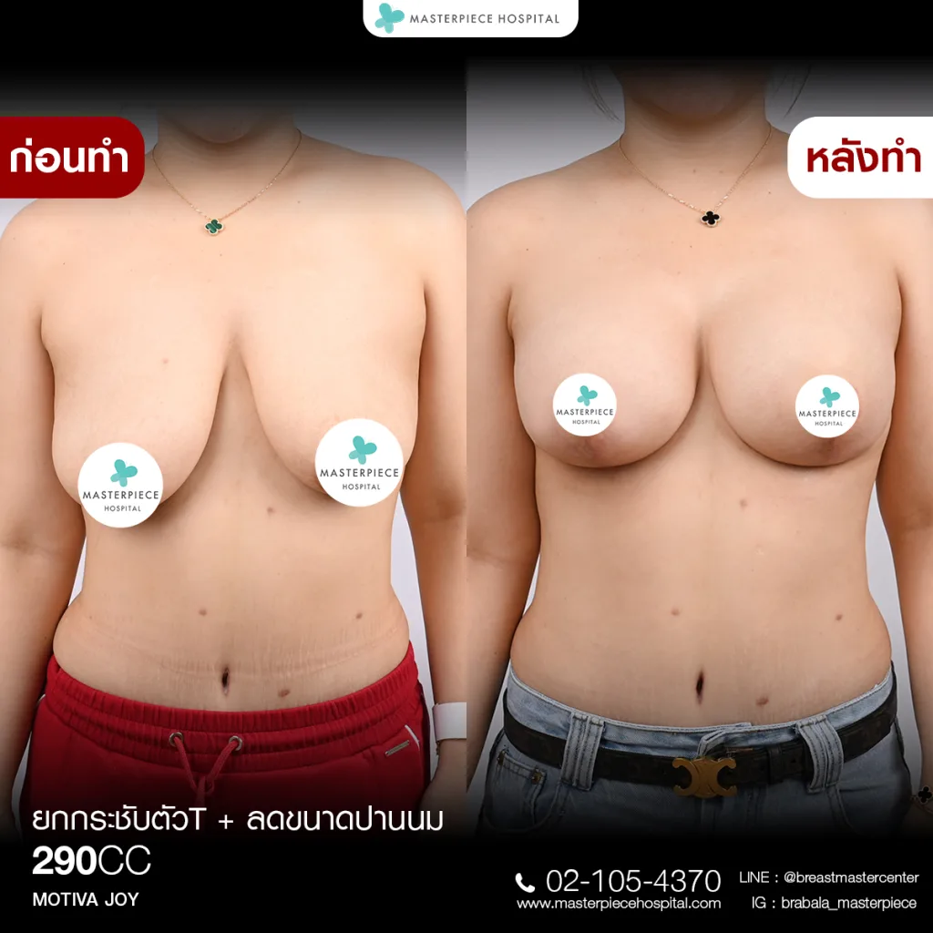 Before & After ยกกระชับหน้าอก 8