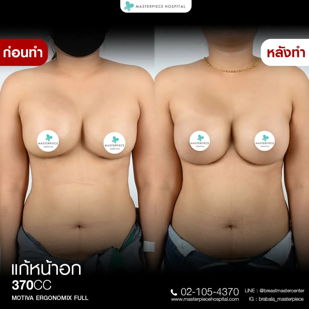 Before & After แก้หน้าอก 9