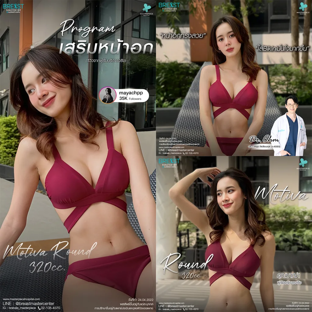 รีวิว เสริมหน้าอก 9