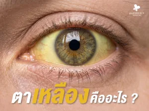 ตาเหลือง (Yellow Eyes) คืออะไร? สาเหตุ อาการ การวินิจฉัย และแนวทางรักษา