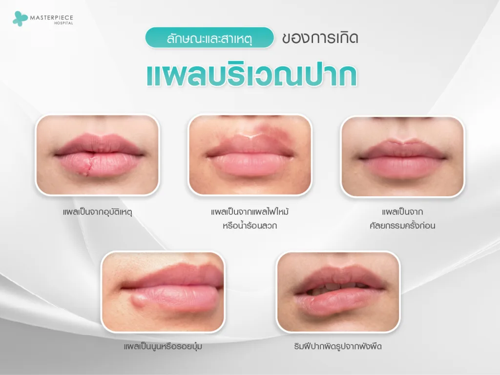 ลักษณะและสาเหตุของการเกิดแผลเป็นบริเวณริมฝีปาก