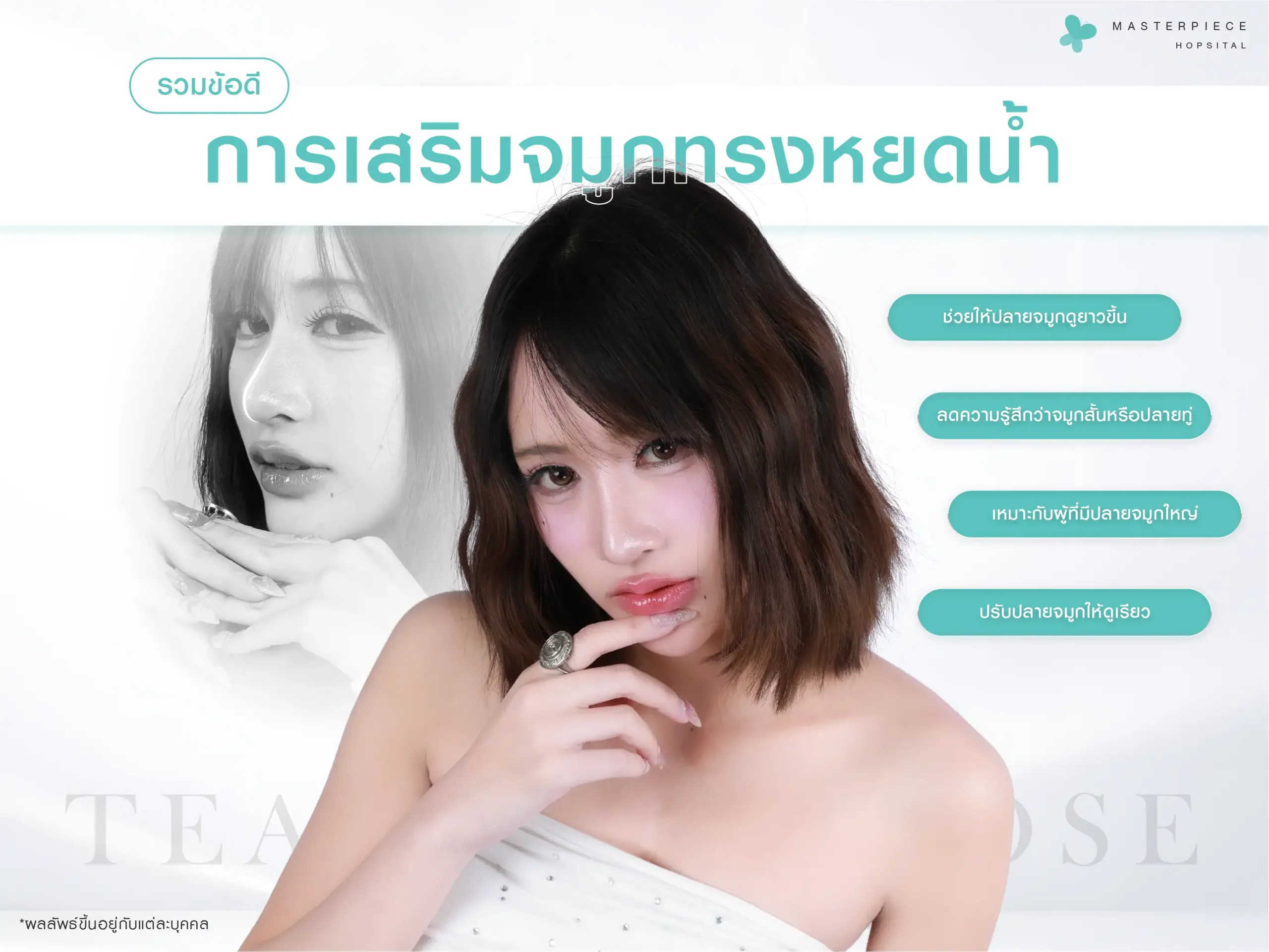 ข้อดีของการเสริมจมูกทรงหยดน้ำที่ช่วยให้ปลายจมูกดูยาวและรับกับริมฝีปาก