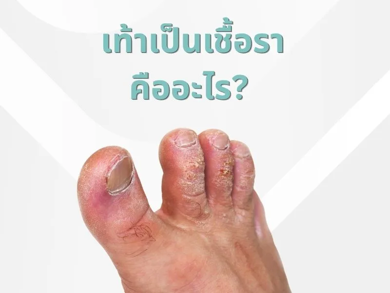 เท้าเป็นเชื้อรา คืออะไร ทำความรู้จักเชื้อราที่เท้า