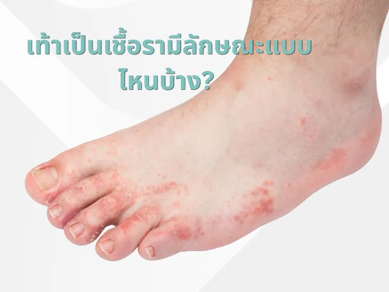 เช็กอาการ เท้าเป็นเชื้อรามีลักษณะแบบไหนบ้าง