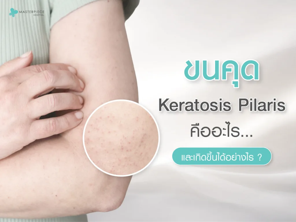 ขนคุด (Keratosis Pilaris) คืออะไร และเกิดขึ้นได้อย่างไร
